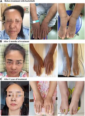 Baricitinib treatment for refractory skin changes in POEMS syndrome: a case report